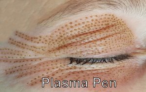 Schulung Plasma Pen